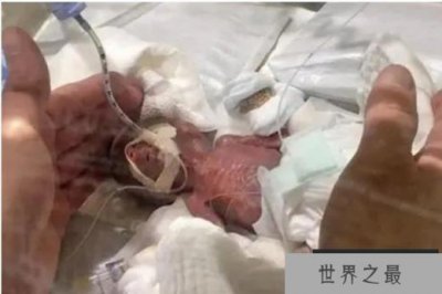 ​世界最小男婴 重量仅268克已平安出院(体重最轻)