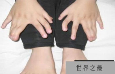​世界上最大的印度男孩有14根手指和20根脚趾