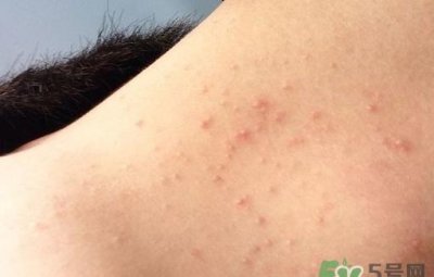 ​脖子上长痘痘是什么原因?脖子上长痘痘怎么治疗?