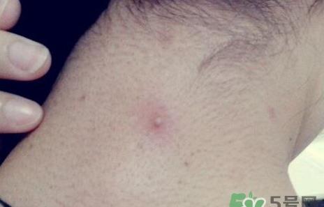 生活脖子上长痘痘是什么原因?脖子上长痘痘怎么治疗?  2