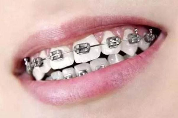 生活牙套的种类和价格 牙套价格一般是多少钱一个  3